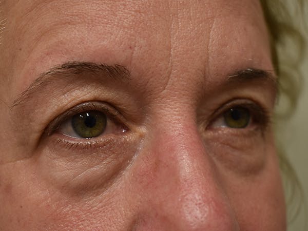 Eyelid Surgery Before & After Gallery - Patient 116341 - Image 3