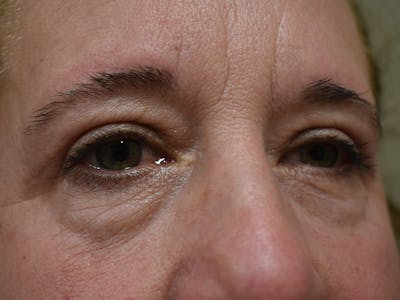 Eyelid Surgery Before & After Gallery - Patient 116341 - Image 4
