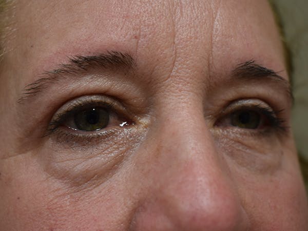 Eyelid Surgery Before & After Gallery - Patient 116341 - Image 4