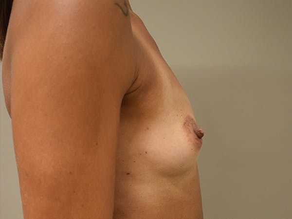 Breast Augmentation Before & After Gallery - Patient 184260 - Image 5