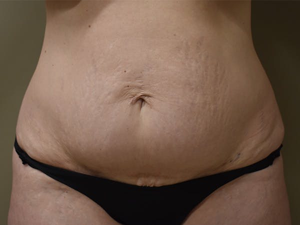 Tummy Tuck Before & After Gallery - Patient 285733 - Image 1