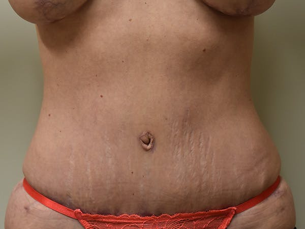 Tummy Tuck Before & After Gallery - Patient 285733 - Image 2