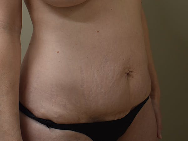 Tummy Tuck Before & After Gallery - Patient 285733 - Image 3