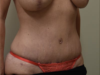 Tummy Tuck Before & After Gallery - Patient 285733 - Image 4