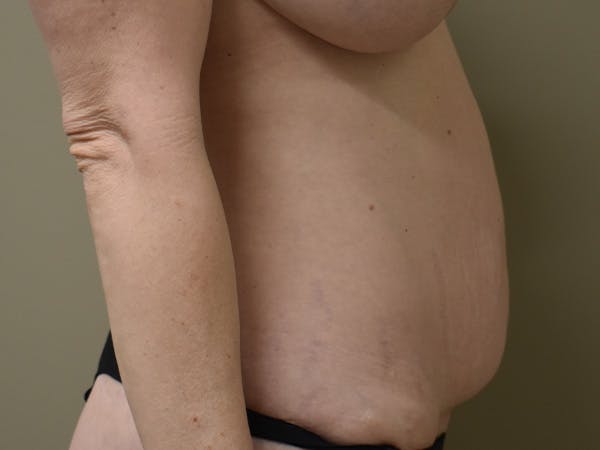 Tummy Tuck Before & After Gallery - Patient 285733 - Image 5