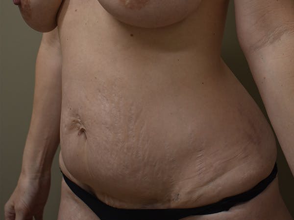 Tummy Tuck Before & After Gallery - Patient 285733 - Image 7