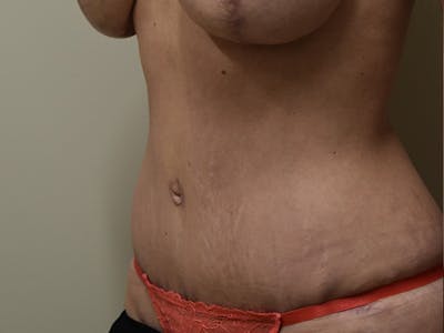 Tummy Tuck Before & After Gallery - Patient 285733 - Image 8
