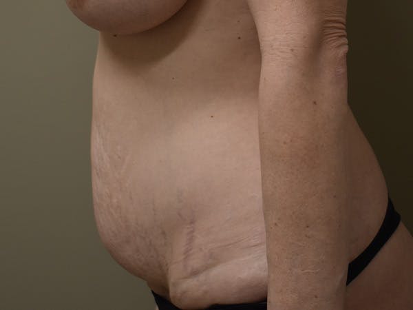 Tummy Tuck Before & After Gallery - Patient 285733 - Image 9