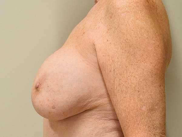 Breast Implant Removal Before & After Gallery - Patient 295396 - Image 9