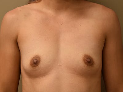 Breast Augmentation Before & After Gallery - Patient 398338 - Image 1