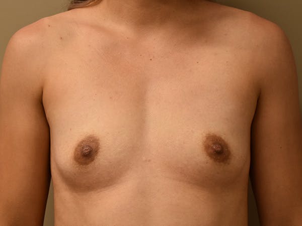 Breast Augmentation Before & After Gallery - Patient 398338 - Image 1