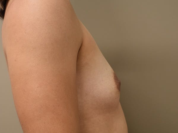 Breast Augmentation Before & After Gallery - Patient 398338 - Image 5