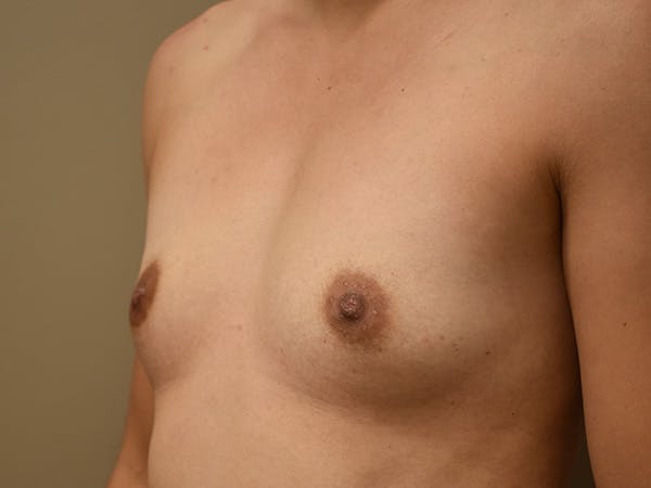 Breast Augmentation Before & After Gallery - Patient 398338 - Image 7