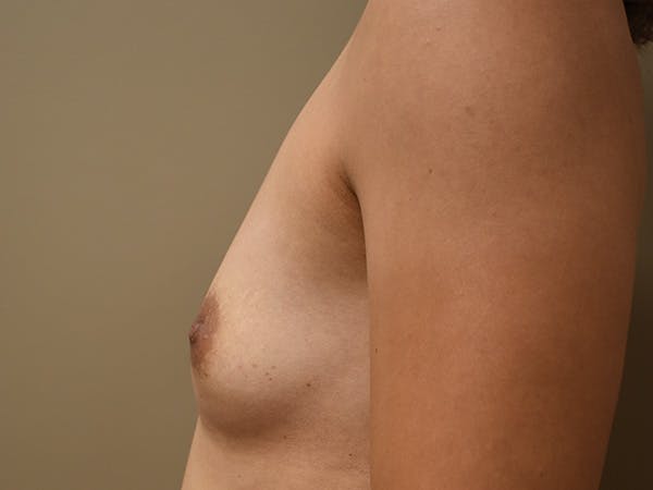 Breast Augmentation Before & After Gallery - Patient 398338 - Image 9