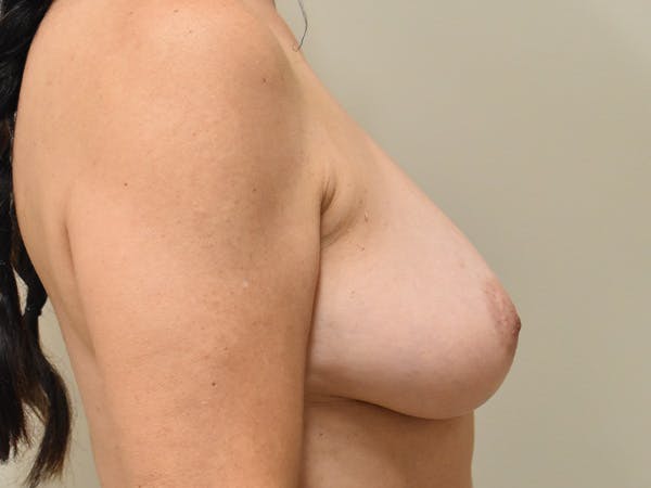 Breast Lift Before & After Gallery - Patient 211058 - Image 5