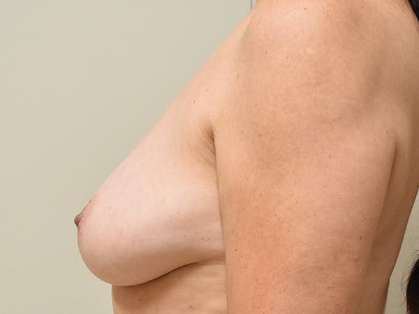 Breast Lift Before & After Gallery - Patient 211058 - Image 9