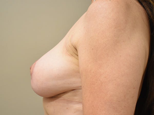 Breast Lift Before & After Gallery - Patient 211058 - Image 10