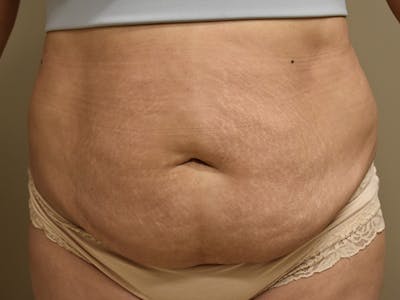 Tummy Tuck Before & After Gallery - Patient 794636 - Image 1