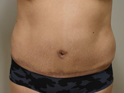 Tummy Tuck Before & After Gallery - Patient 794636 - Image 2