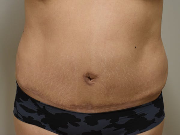 Tummy Tuck Before & After Gallery - Patient 794636 - Image 2
