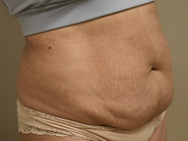 Tummy Tuck Before & After Gallery - Patient 794636 - Image 3