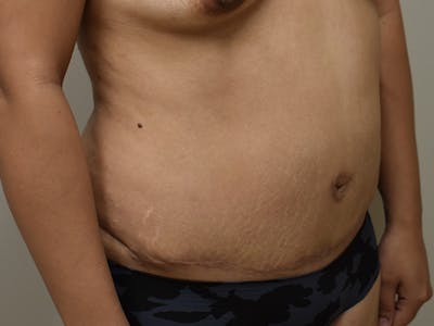Tummy Tuck Before & After Gallery - Patient 794636 - Image 4