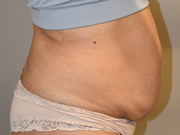 Tummy Tuck Before & After Gallery - Patient 794636 - Image 5