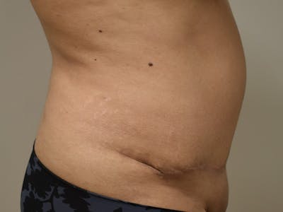 Tummy Tuck Before & After Gallery - Patient 794636 - Image 6