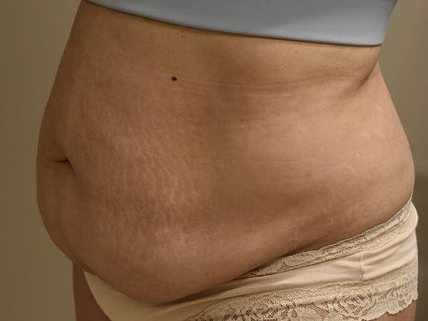 Tummy Tuck Before & After Gallery - Patient 794636 - Image 7