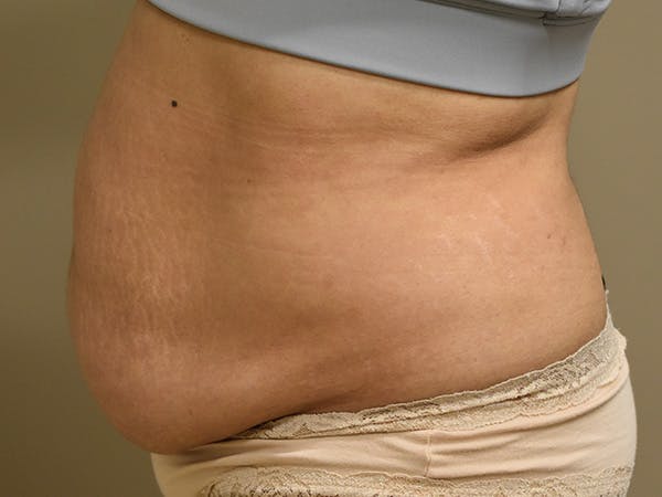 Tummy Tuck Before & After Gallery - Patient 794636 - Image 9