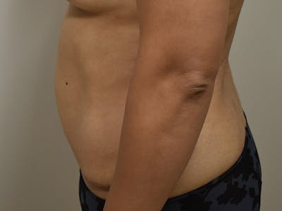 Tummy Tuck Before & After Gallery - Patient 794636 - Image 10