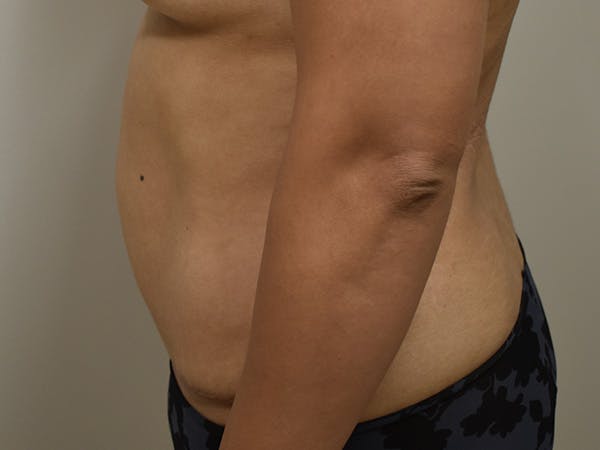 Tummy Tuck Before & After Gallery - Patient 794636 - Image 10