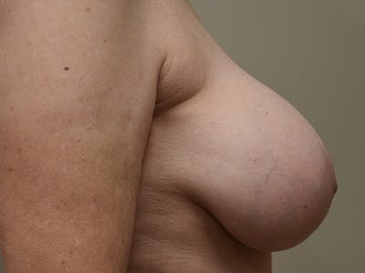 Breast Correction Before & After Gallery - Patient 356350 - Image 6