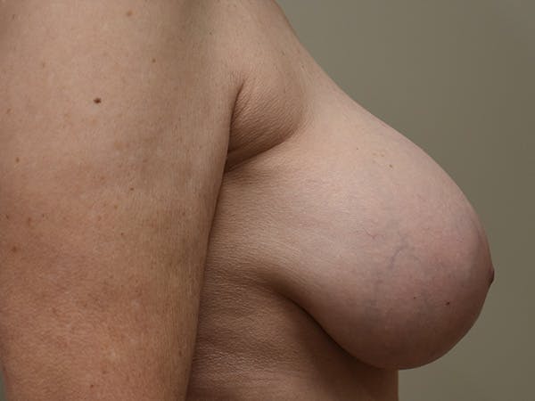 Breast Correction Before & After Gallery - Patient 356350 - Image 6