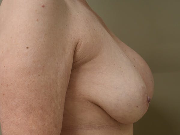 Breast Correction Before & After Gallery - Patient 356350 - Image 5