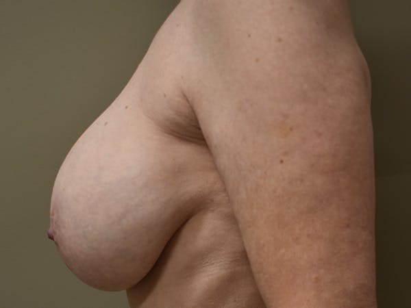 Breast Correction Before & After Gallery - Patient 356350 - Image 9
