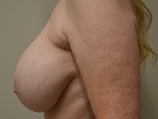 Breast Correction Before & After Gallery - Patient 356350 - Image 10