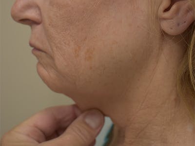 Mini Facelift Before & After Gallery - Patient 875941 - Image 1