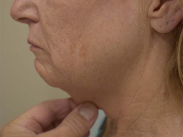 Mini Facelift Before & After Gallery - Patient 875941 - Image 1