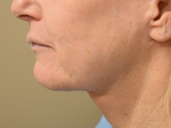 Mini Facelift Before & After Gallery - Patient 875941 - Image 2