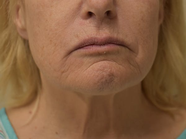 Mini Facelift Before & After Gallery - Patient 875941 - Image 3