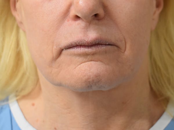 Mini Facelift Before & After Gallery - Patient 875941 - Image 4