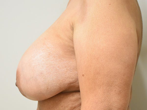 Breast Implant Removal Before & After Gallery - Patient 365337 - Image 9