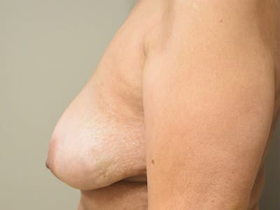 Breast Implant Removal Before & After Gallery - Patient 365337 - Image 10