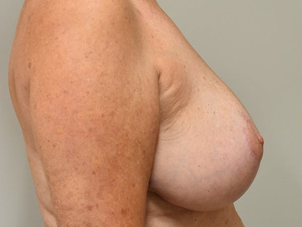 Breast Reduction Before & After Gallery - Patient 545648 - Image 6
