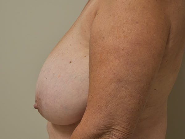 Breast Reduction Before & After Gallery - Patient 545648 - Image 9