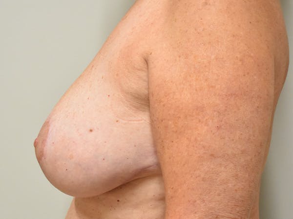 Breast Reduction Before & After Gallery - Patient 545648 - Image 10