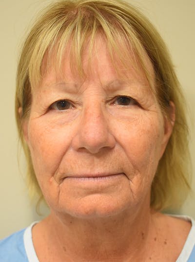 Facelift Before & After Gallery - Patient 405209 - Image 1