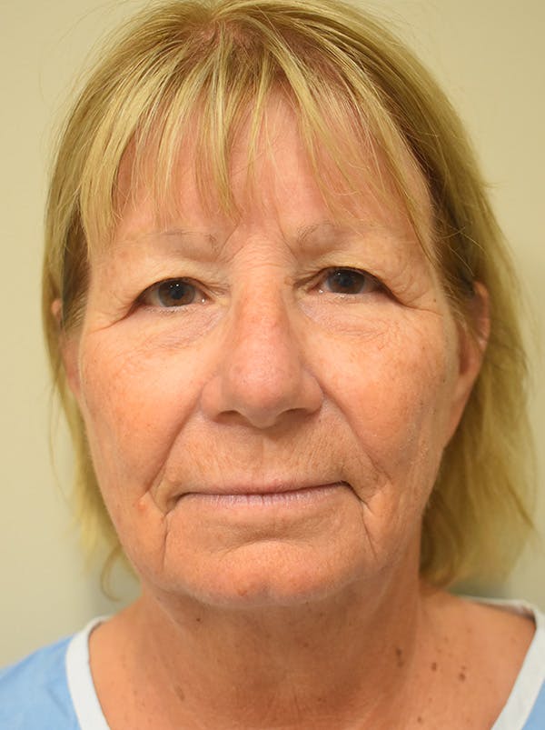 Facelift Before & After Gallery - Patient 405209 - Image 1