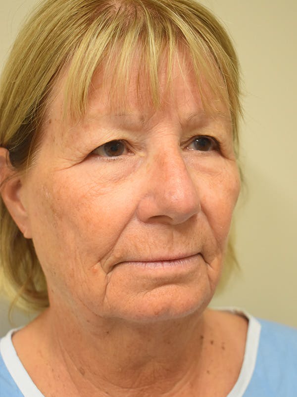 Facelift Before & After Gallery - Patient 405209 - Image 3